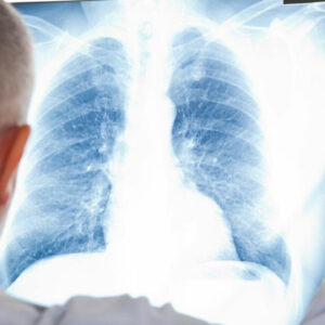 A few things you should know about mesothelioma cancer