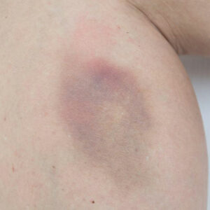 Easy bruising – Causes and treatments