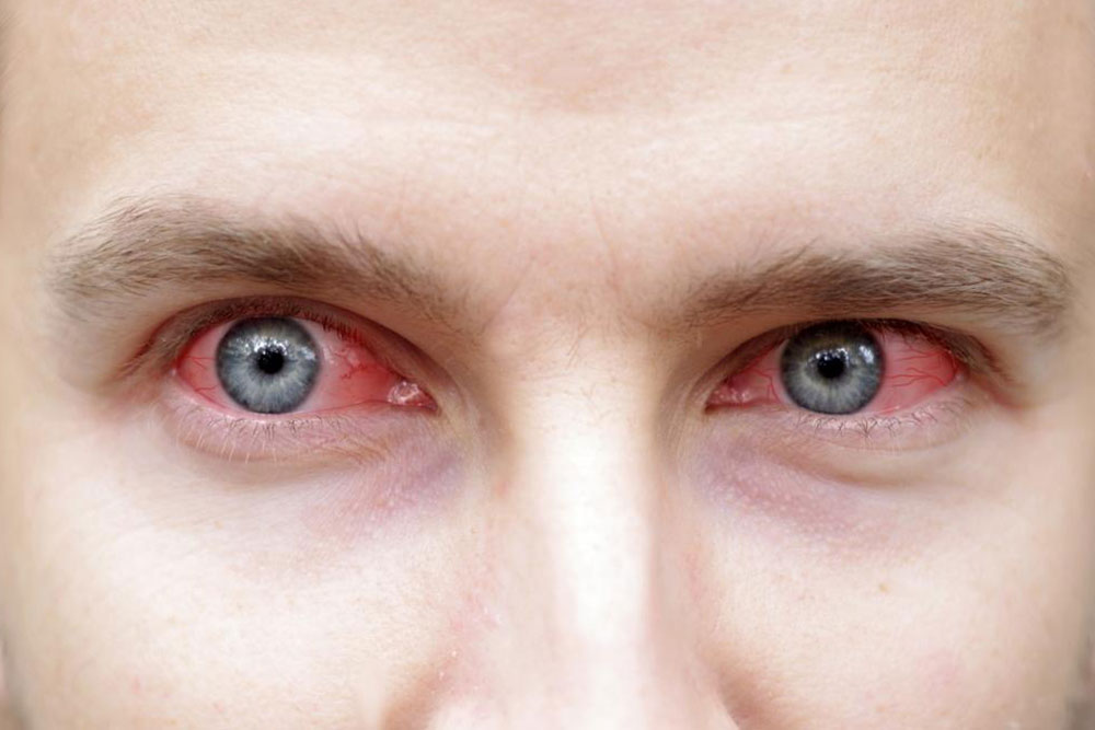 Tips to control the symptoms of Sjogren’s syndrome effectively