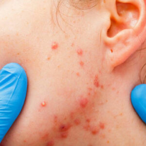 What you need to know about the types and stages of myeloma