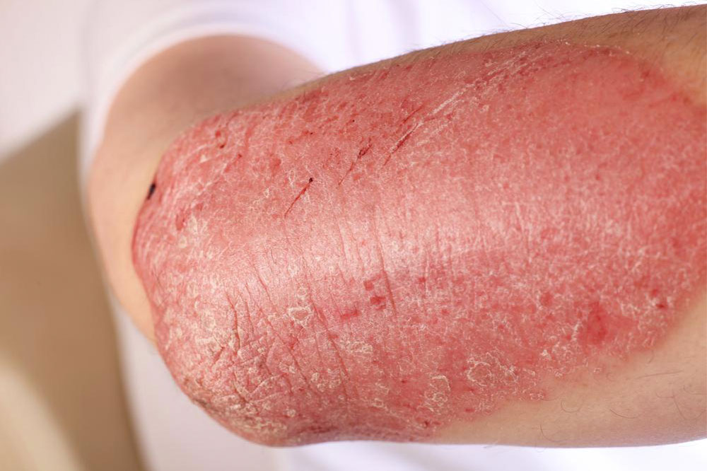 Immune system disorder – Symptoms, causes, and risks