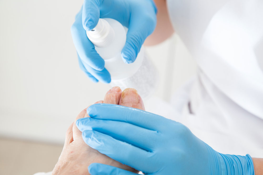 Toenail Fungus – Symptoms and Treatment Methods